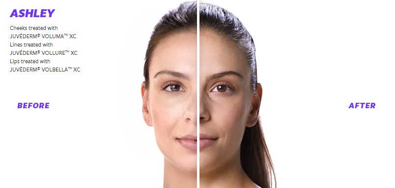JUVÉDERM Before and After